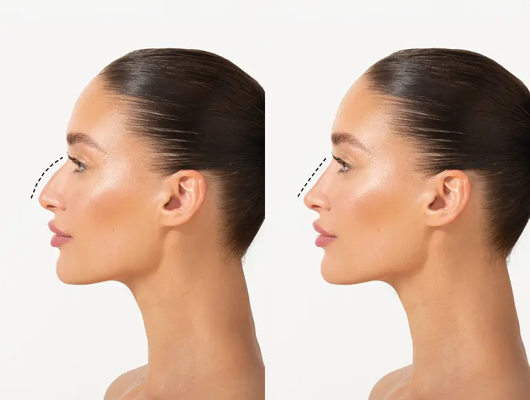 Non-Surgical Nose Job